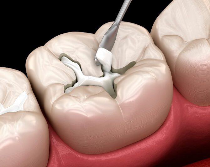Tooth Colored Fillings